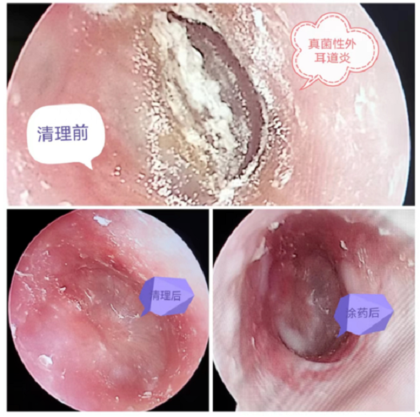 耳朵竟得了“腳氣”