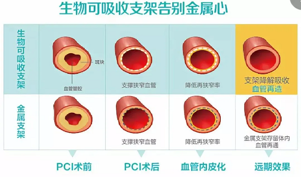 冠心病患者福音！我院成功完成首例可吸收支架植入！